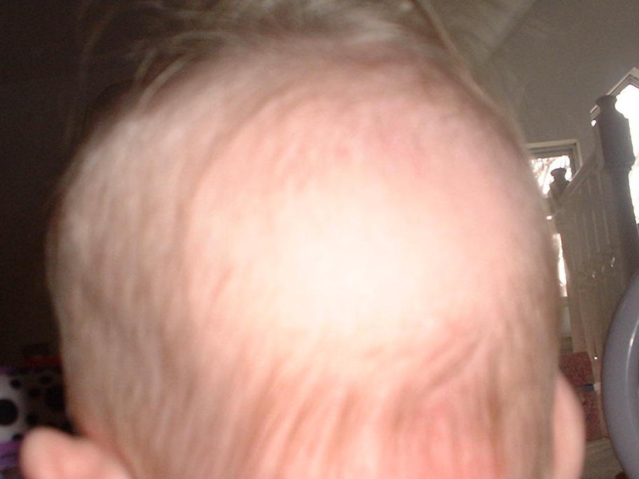 bald spot 2.JPG